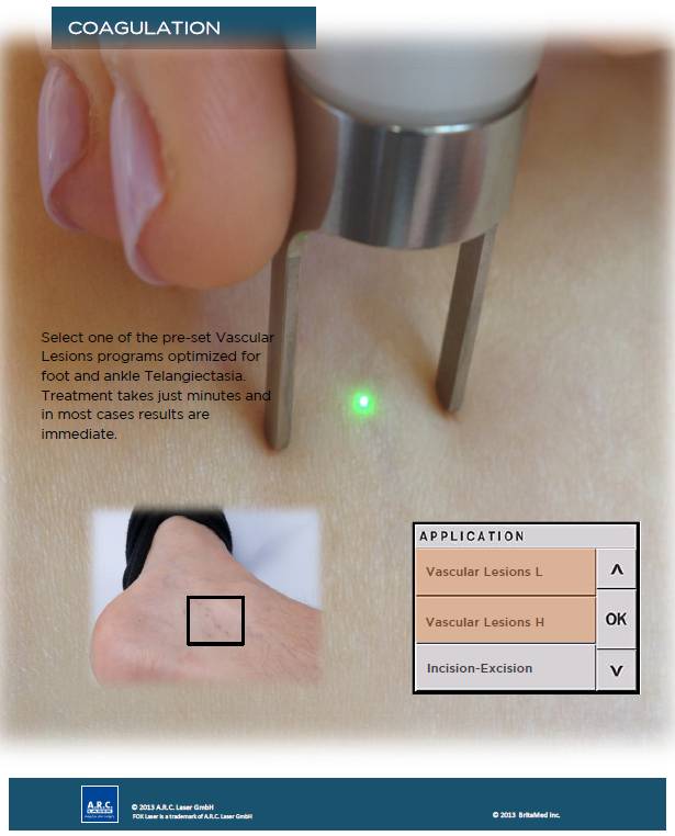 FOX Podiatry Laser | BritaMed Inc.